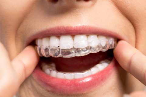 Licówki – rozwiązanie problemu krzywych zębów